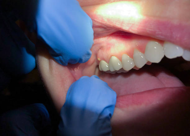 Best Emergency Tooth Extraction in Knightdale, NC