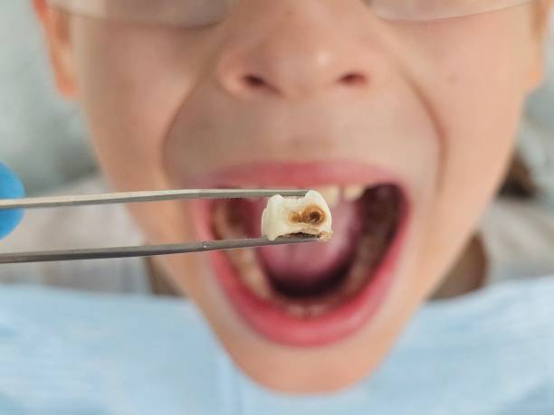 Best Emergency Tooth Extraction in Knightdale, NC